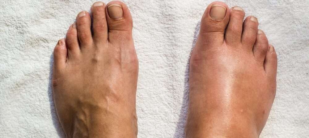 Two swollen human feet