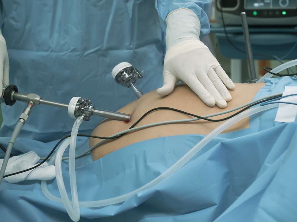 A surgeon doing bariatric surgery with laparoscopic instruments