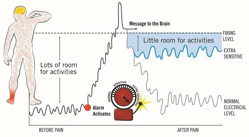 Nervous System Sensitisation in Persistent Pain - Paragon PsychConnect Diagram comparing normal pain signalling with a sensitised nervous system that has a lower firing threshold and less room for activity